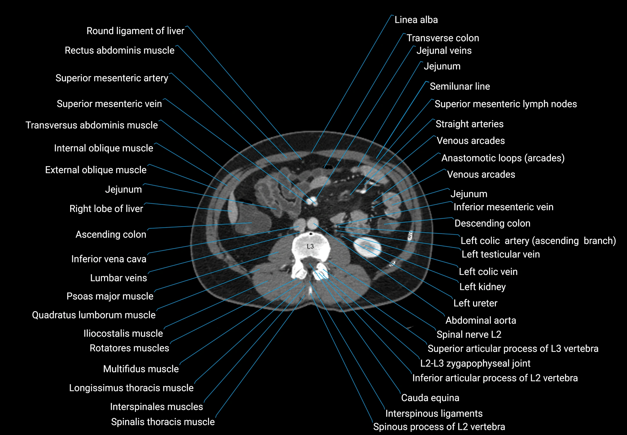 CT male pelvis axial cross sectional anatomy labelled radiology image -00086.webp
